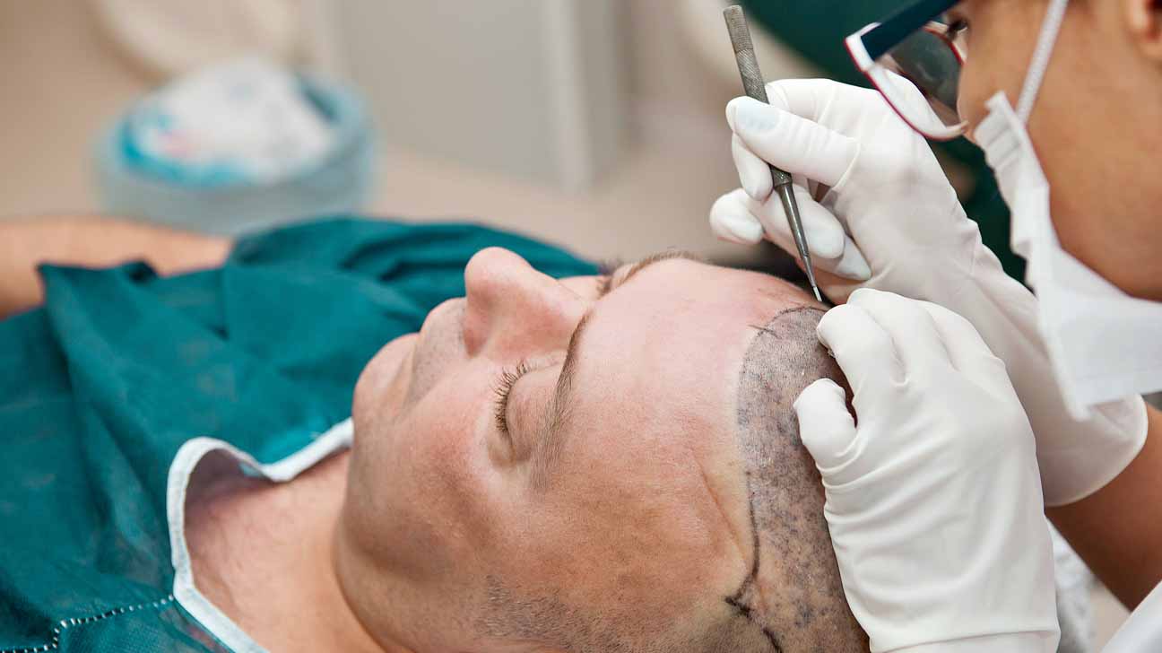 Your Guide to Hair Transplant Surgery in Turkey 2